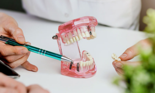 Implantes Dentales